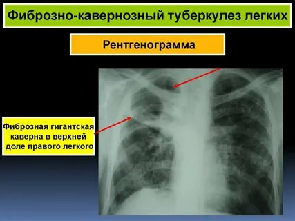 Фиброзные изменения в правом легком
