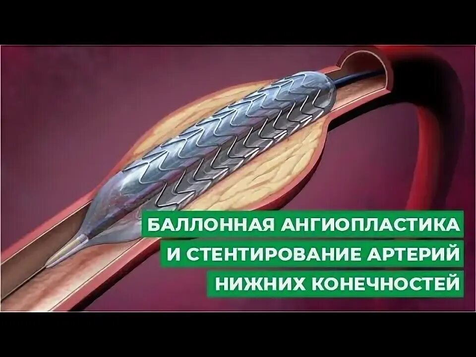 Баллонная ангиопластика нижних конечностей. Баллонная ангиопластика и стентирование. Баллонная ангиопластика и стентирование нижних конечностей. Баллонная ангиопластика коронарных артерий. Ангиопластика сосудов нижних конечностей.