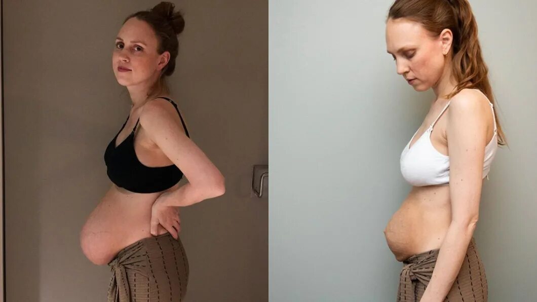 После беременности. Женщины до и после беременности. Живот родившей женщины. Живот беременных после родов. Pregnant до и после.