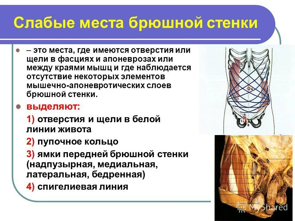 мышцы живота белая линия паховый канал. слабые места брюшной. перечислите слабые места передней брюшной стенки. слабые места брюшной. слабые места брюшной стенки живота анатомия.