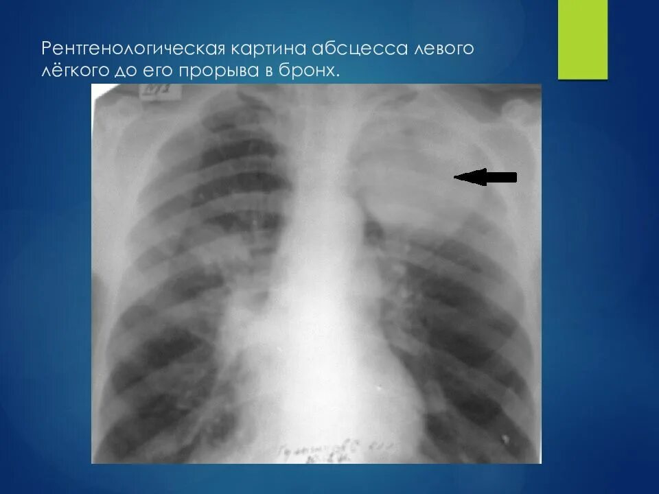 После абсцесса легкого. Стадии абсцесса легкого рентген. Рентгенография абсцесса легкого. Рентген при абсцессе легкого. Рентгенологическая картина абцесс легкого.