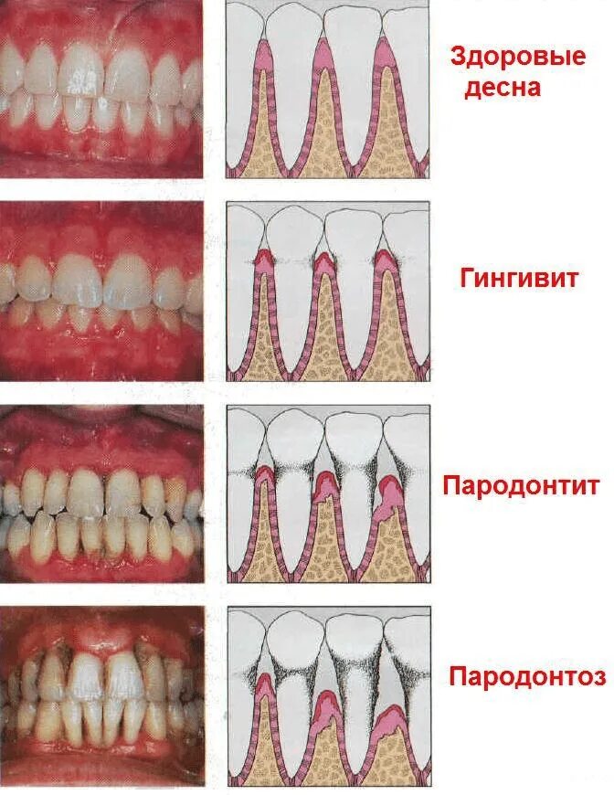 Исправляем форму десен. Хронический локализованный пародонтит. Десквамативный гингивит. Язвенно некротический гинг. Гангренозный пародонтит.