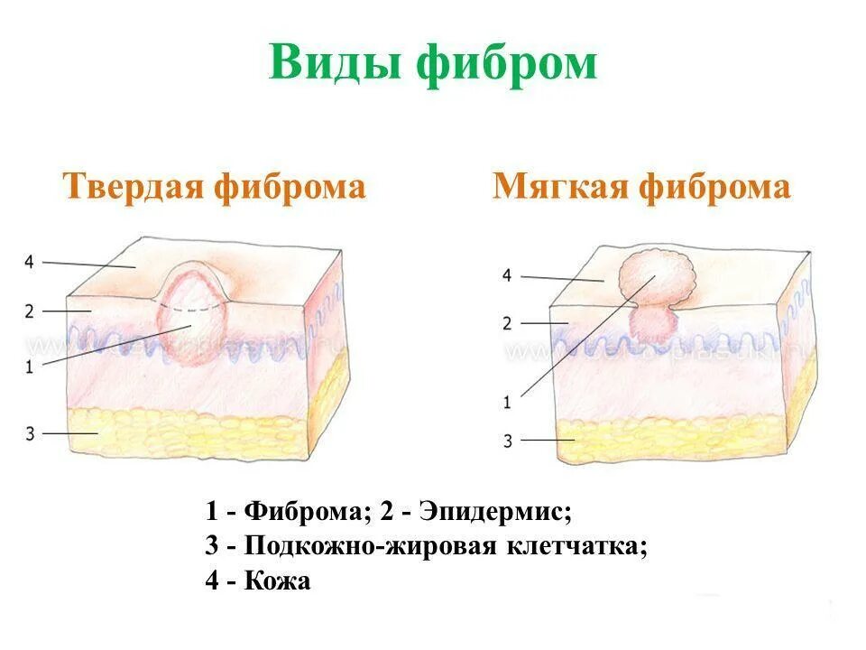 Плотный появление. Твёрдая подкожная фиброма кожи.