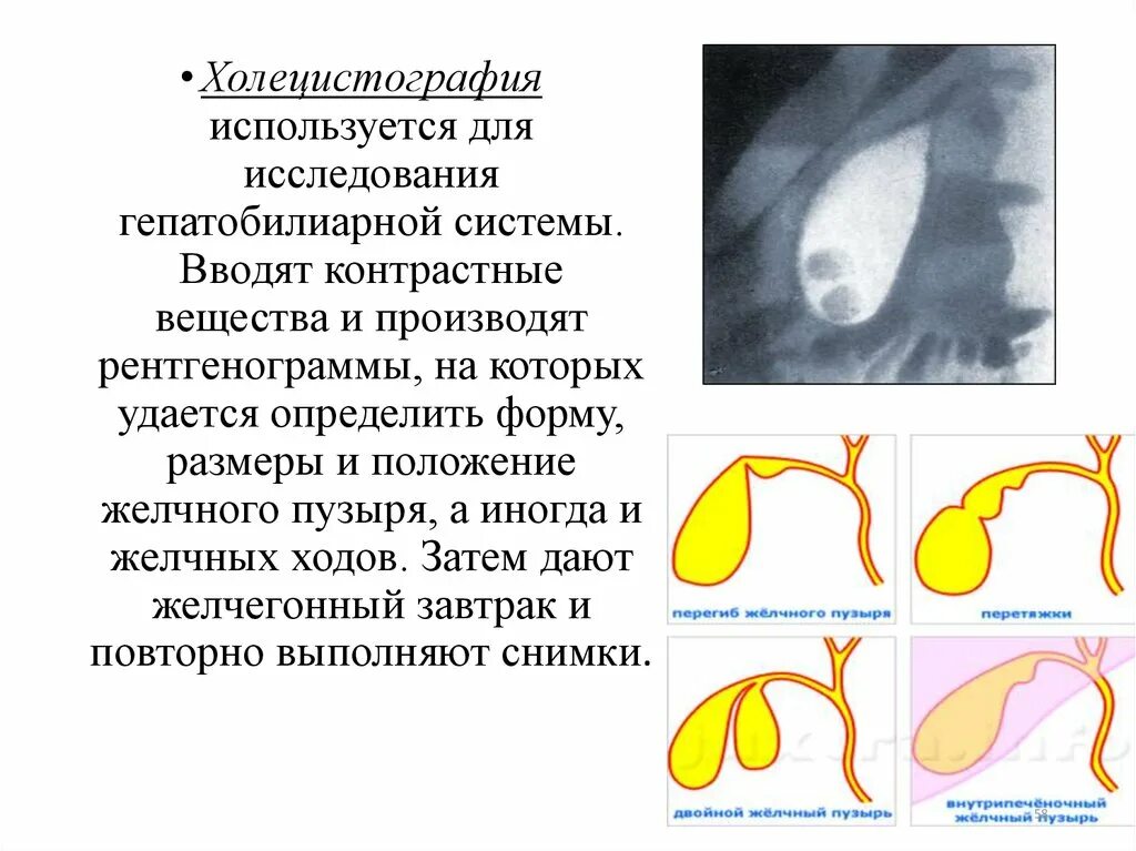 Пероральная холецистография. Холецистография желчного пузыря. Методика исследования перорального холецистография. Рентген с контрастом желчного пузыря. Ультразвуковая динамическая холецистография.