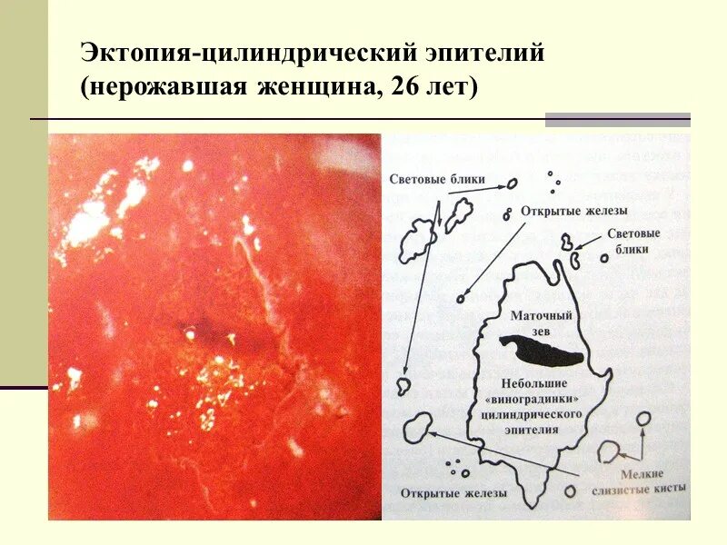 Эктопия диагностика. Эктопия диагностика. Кольпоскопия зона трансформации 2 типа. Эктопия диагностика. Врожденная эрозия шейки матки.