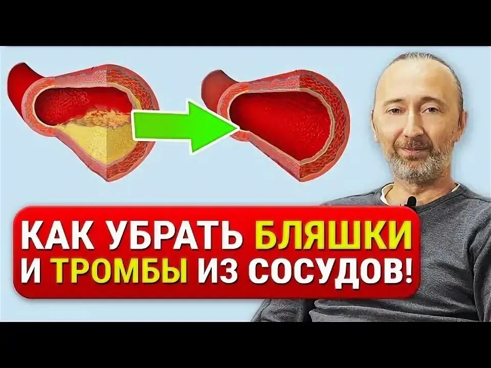 Чистка сосудов от тромбов и бляшек. Как почистить сосуды от холестериновых бляшек. Чем можно почистить сосуды человеку дома. От бляшек и тромбов как очистить