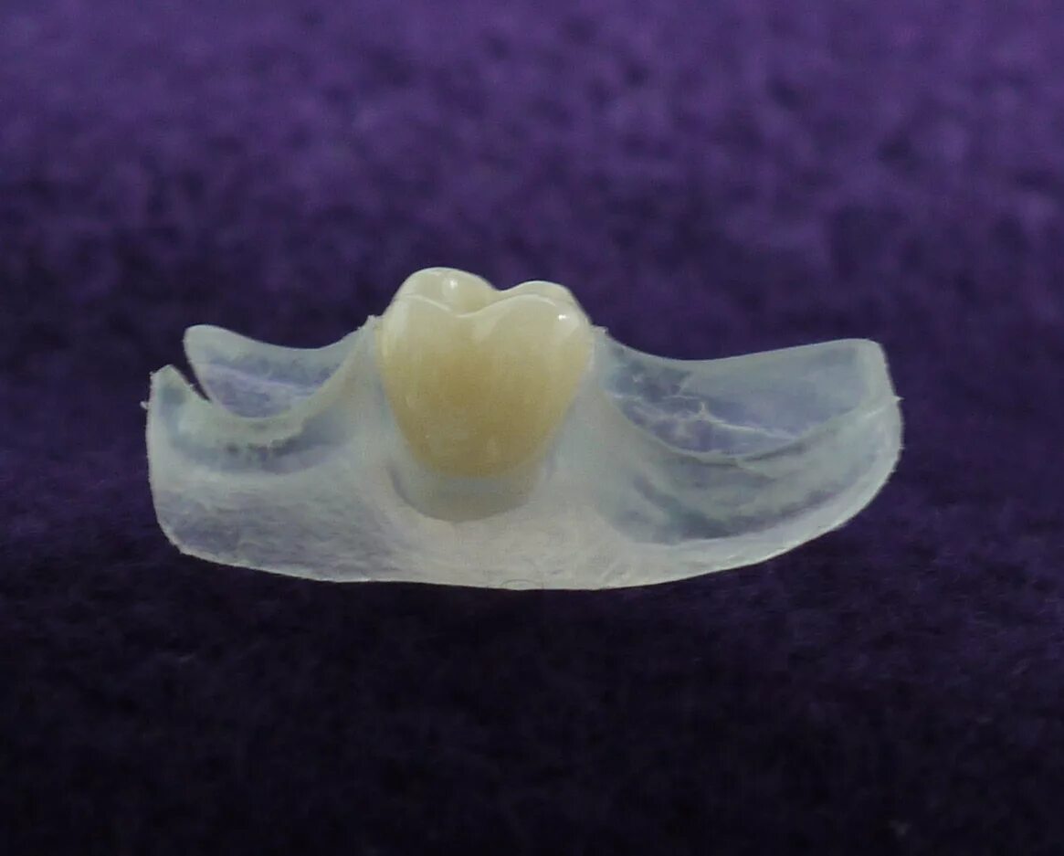 Микропротез бабочка на 1. Иммедиат протез бабочка 1 зуб передний. Микропротез бабочка на 1 зуб. Изготовление иммедиат протеза