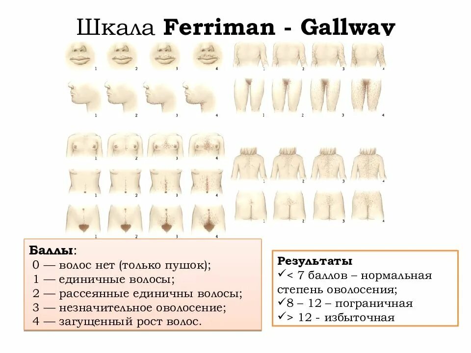В каком возрасте начинают расти волосы. Женский Тип оволосения. Степень оволосения у женщин. Типы оволосения у женщин. Нормальное оволосение у женщин.