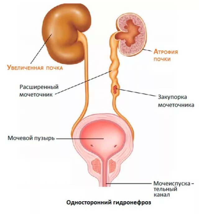 Будет расширена тем самым. Расширение лоханки гидронефроз. Камень мочеточника с гидронефрозом. Расширение лоханки почки пиелоэктазия. Почки мочеточники мочевой пузырь строение.