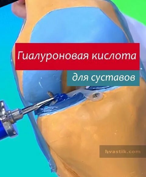 Гиалуроновая кислота для суставов. Гиалуроновая кислота для суставов уколы. Гиалуроновая кислота в колено.