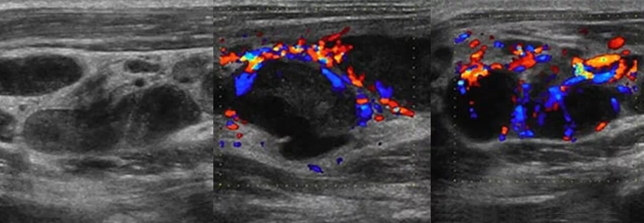 Ультразвуковое исследование щитовидной железы и лимфоузлы. Подчелюстные лимфоузлы на УЗИ. УЗИ диагностика лимфатических узлов. Метастатические лимфоузлы