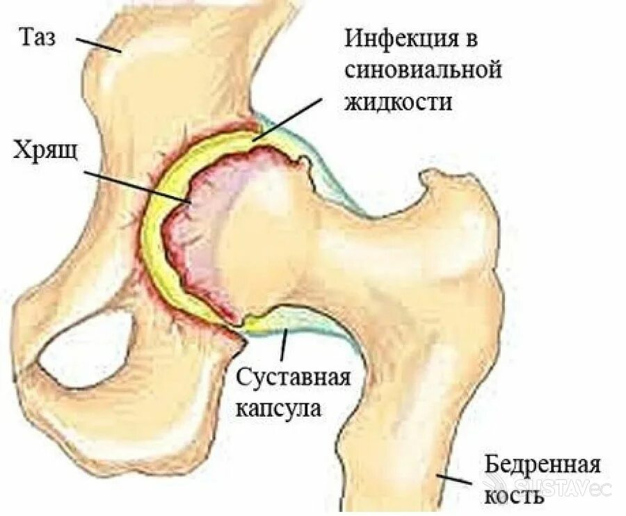 Тазобедренный артрит у ребенка. Септический артрит тазоберненногосустава. Септический артрит тазобедренного сустава. Септический артрит тазобедренного сустава рентген. Двусторонний синовит тазобедренного сустава.