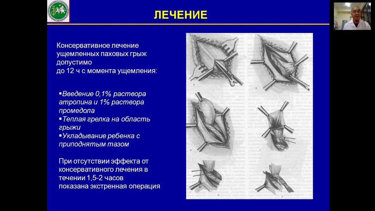 Паховая грыжа методы лечения. Грыжесечение ущемленной грыжи. Ущемленная косая паховая грыжа. Врожденная паховая грыжа клинические. Паховое грыжесечение детское.