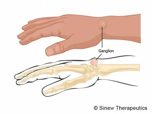 Ганглион кистевого сустава. Ганглий лучезапястного. Ганглий сухожилия кисти.