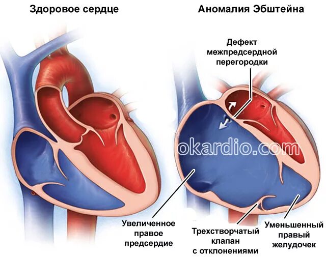 Аномалия Эбштейна. Аномалия Эбштейна сердца.