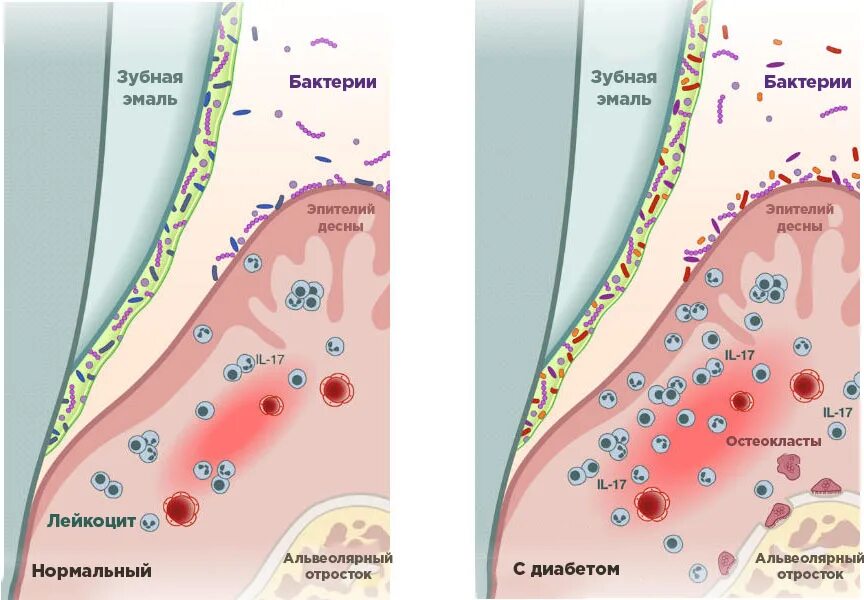 Гигиена полости рта с брекет системой. Шатающийся зуб на снимке. Патогенез пародонтита при сахарном диабете. Сахарный диабет в ротовой полости. Зубы при сахарном диабете 2 типа.