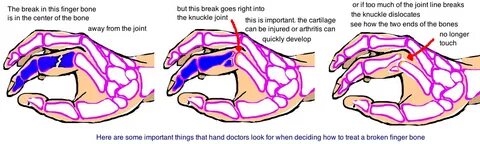 Broken finger