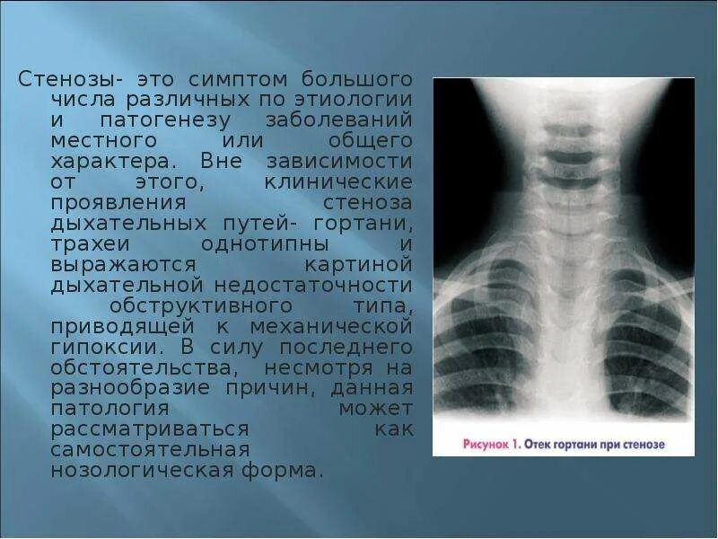 стеноз дыхательных путей. сужение дыхательных путей. стеноз дыхательных. сужение просвета дыхательных путей. стеноз дыхательных.