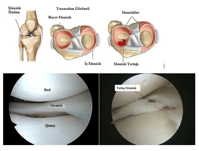 Разрыв медиального мениска коленного сустава. Повреждение внутреннего мениска. Структурные изменения мениска