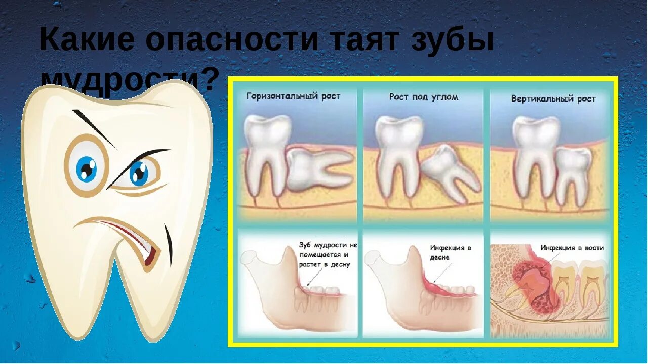 Сколько зубов мудрости может быть у человека. Строение зуба мудрости человека. Зубы МУБ.