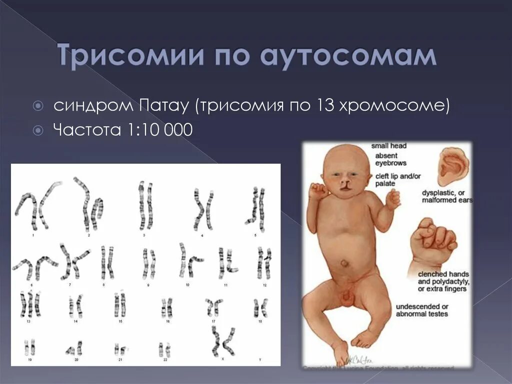 Пересадка хромосом. Синдром Патау трисомия по 13 хромосоме кариотип. Синдром Эдвардса (трисомия по 18 паре хромосом). Синдром Патау трисомия по 13 хромосоме. Внешние проявления Патау.