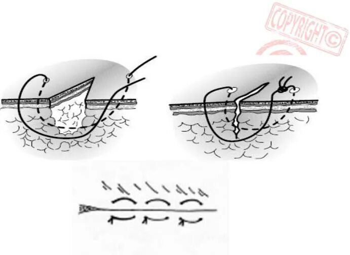 Ушивание разрывов. Внутридермальный непрерывный шов. Хирургическая игла для зашивания РАН. Косметический шов схема. Саморассасывающиеся косметические швы.
