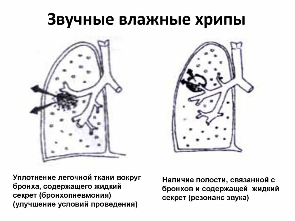 Звонкие хрипы. Механизм возникновения влажных мелкопузырчатых хрипов. Звучные влажные хрипы. Звучные и незвучные хрипы. Механизм образования влажных хрипов.