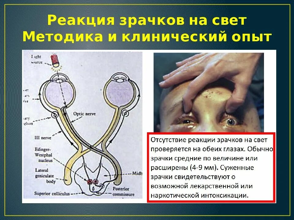 Резкая реакция на свет. Отсутствие зрачкового рефлекса. Отсутствие реакции зрачка на свет. Реакция зрачка на свет рефлекс.