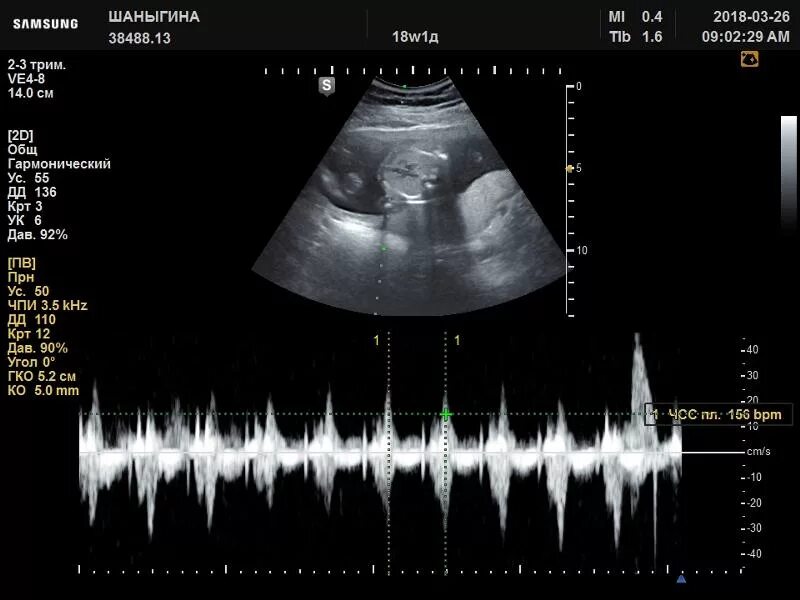 Первое сердцебиение плода. Первое сердцебиение плода на УЗИ. Сердцебиение на УЗИ. УЗИ 18 недель норма. УЗИ плода 18 недель норма.