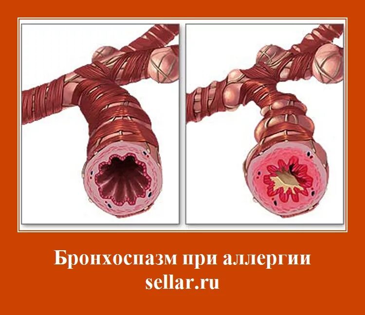 Скрытый бронхоспазм