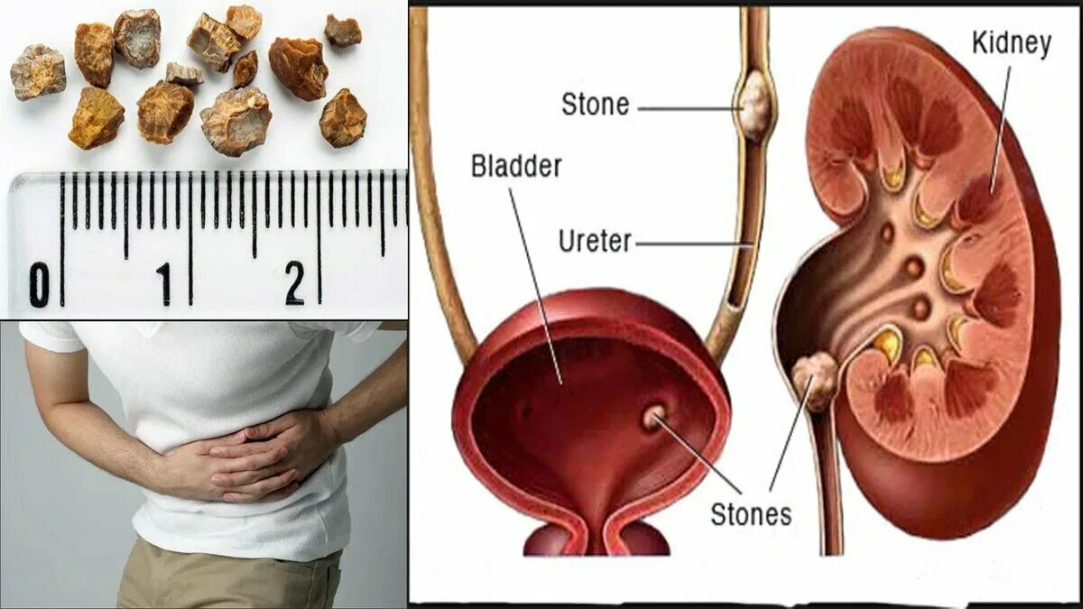 Мочевой пузырь печень. Treatment of chronic Pyelonephritis.