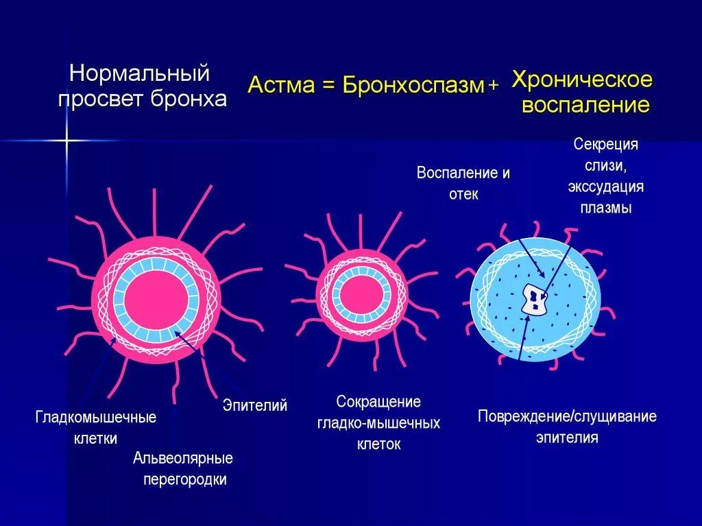 Бронхиальная астма бронхоспазм. Сужение бронхов бронхоспазм.