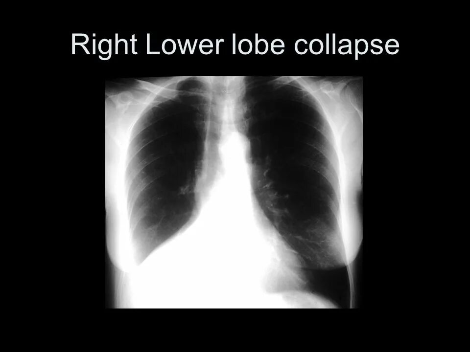 Left lower Lobe Collapse. Ателектаз и коллапс легкого. Right inferior Lobe. Atelectasis right lower Lobe. Sang right