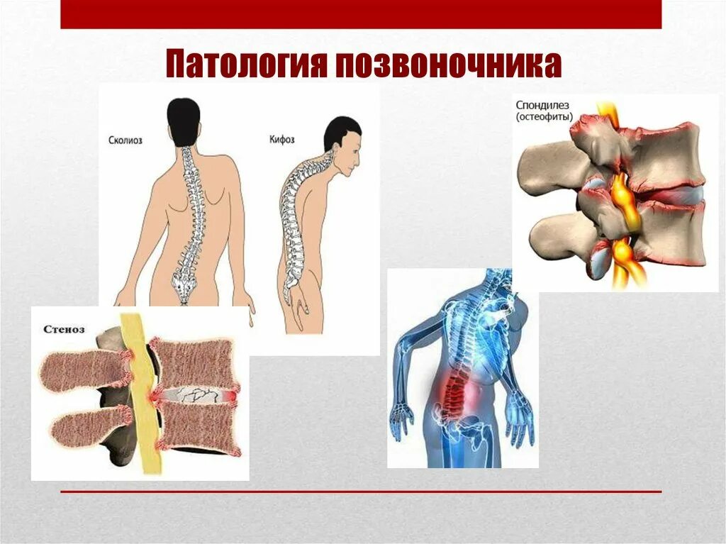 Что патология и тем. Нарушение позвоночника. Позвоночные заболевания. Болезни спины. Позвоночник человека аномалии.