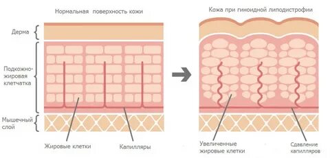 Воспаление клетчатки кожи