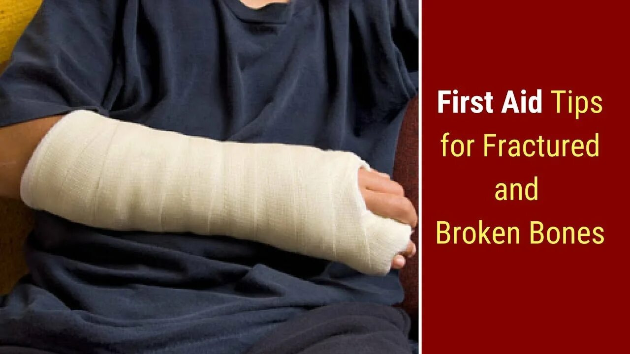 A fracture is a broken bone. A fracture is a broken bone
