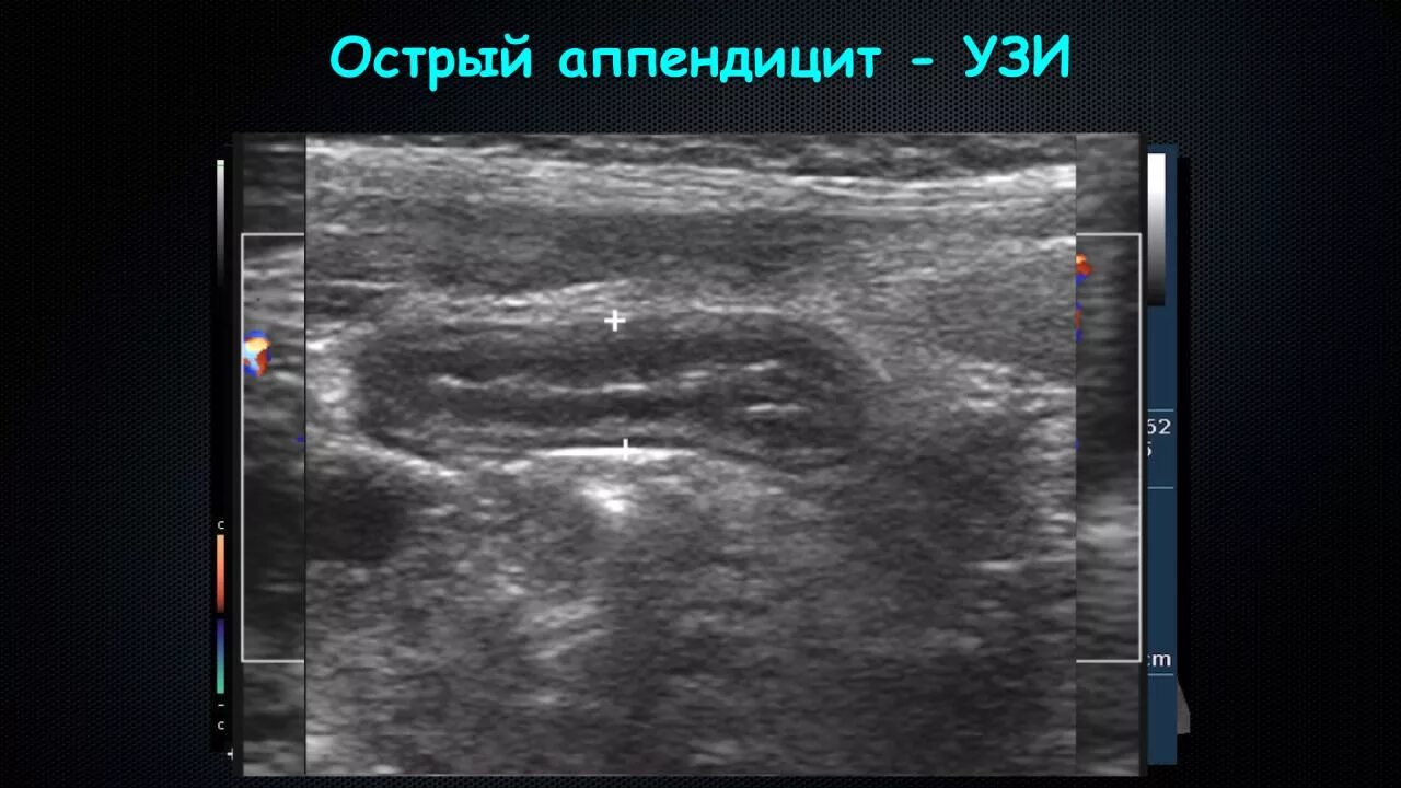 Воспаление червеобразного отростка УЗИ. Аппендикулярный отросток на УЗИ. Воспаленный аппендикс на УЗИ. УЗИ картина острого аппендицита. На узи видно воспаление