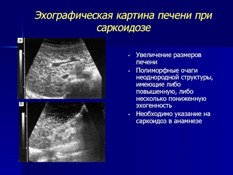 Очаговое образование селезенки. Саркоидоз печени УЗИ картина. Саркоидоз селезенки на УЗИ. УЗИ при саркоидозе печени.