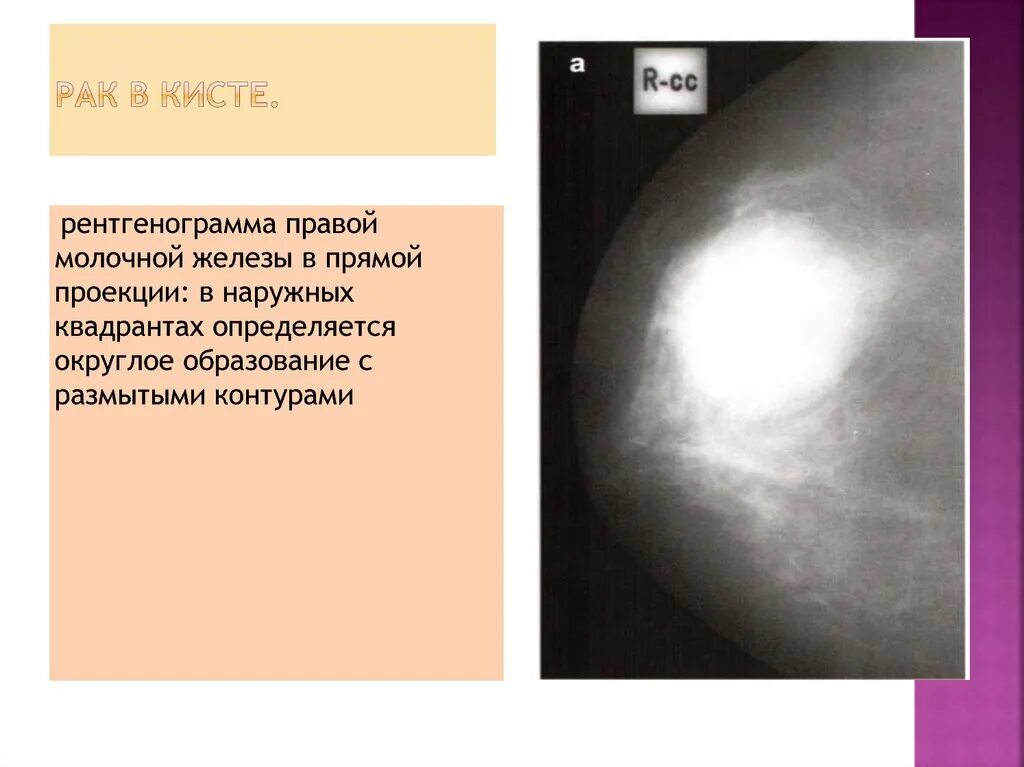 Округлые образования в молочной железе