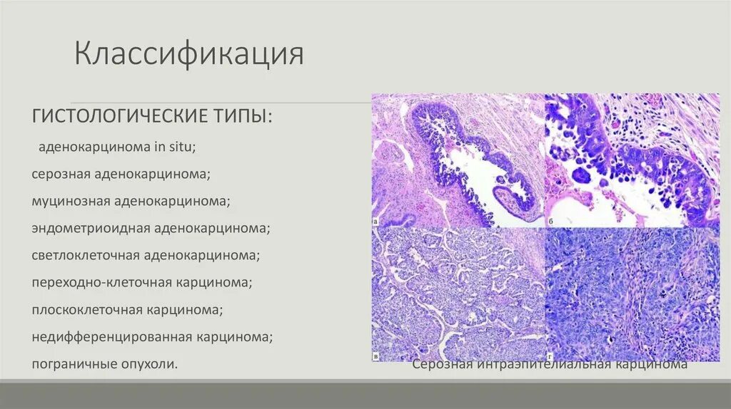 Low grade яичников. Гистологические типы аденокарциномы. Светлоклеточная аденокарцинома гистология. Серозная цистаденофиброма гистология. Аденокарцинома маточной трубы гистология.