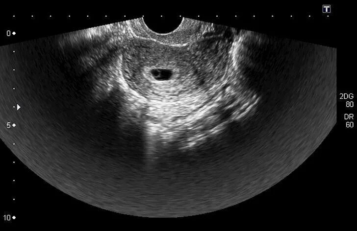 Шейка 6 недель. Плодное яйцо на 6 неделе беременности УЗИ. Плодное яйцо 5 недель на УЗИ беременность 6. УЗИ 6 недель беременности плодное яйцо на УЗИ. Желточный мешок при беременности на УЗИ 5 недель.