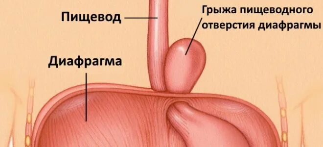 Грыжа диафрагмального отверстия пищевода. Операция грыжи желудка диафрагмы. Грыжа пищевод желудок диафрагмы. Грыжа пищеводного отверстия пищевода симптомы. Грыжа пищеводного отверстия симптомы лечение