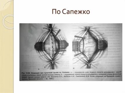 Мкб передней брюшной стенки