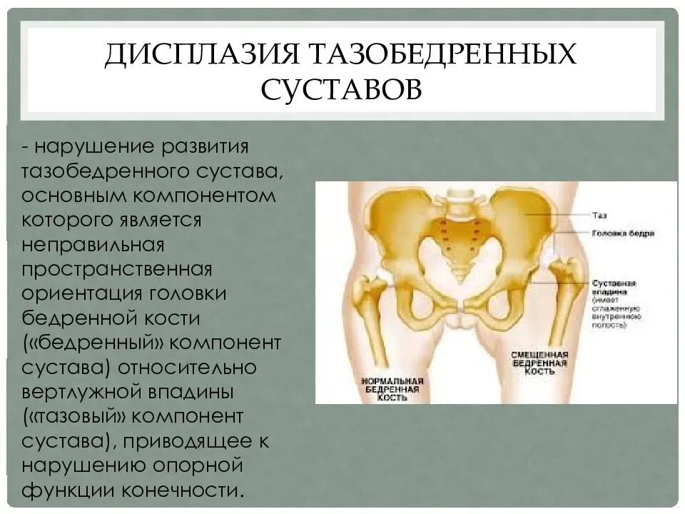 Дисплазия сустава у новорожденного лечение