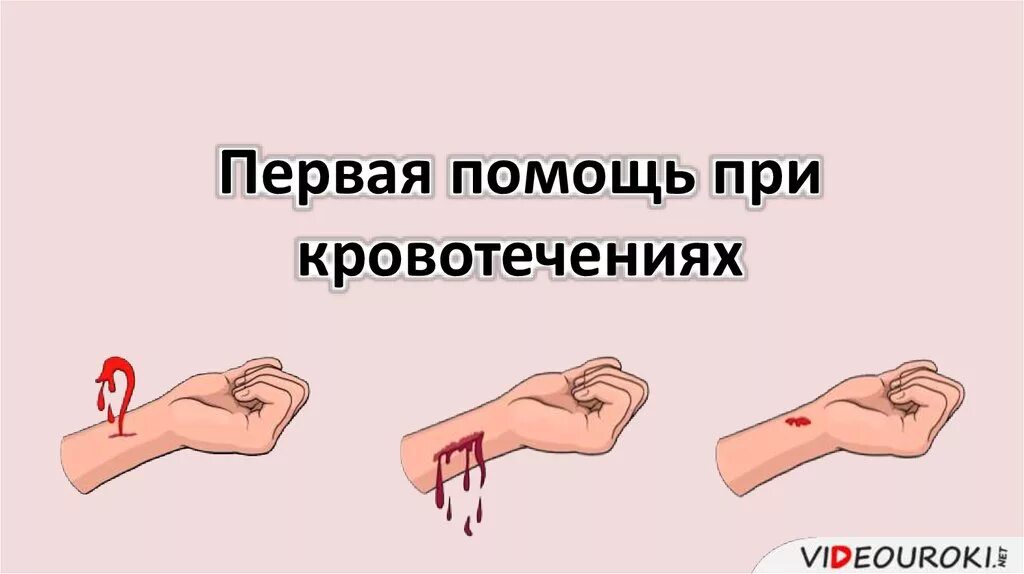 Первая помощь при кровоти. Кровотечение первая помощь. Оказание первой помощи при кровотечении. Оказание первой медицинской помощи при кровотечениях.