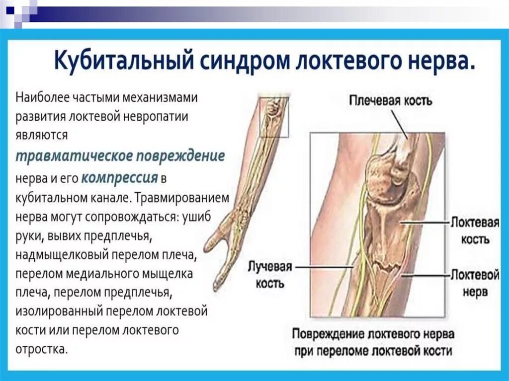 Невропатия локтевого нерва мкб. Кубитальный туннельный синдром. Компрессионная нейропатия локтевого нерва. Синдром сдавления локтевого нерва. Компрессионная ишемическая нейропатия лучевого нерва.