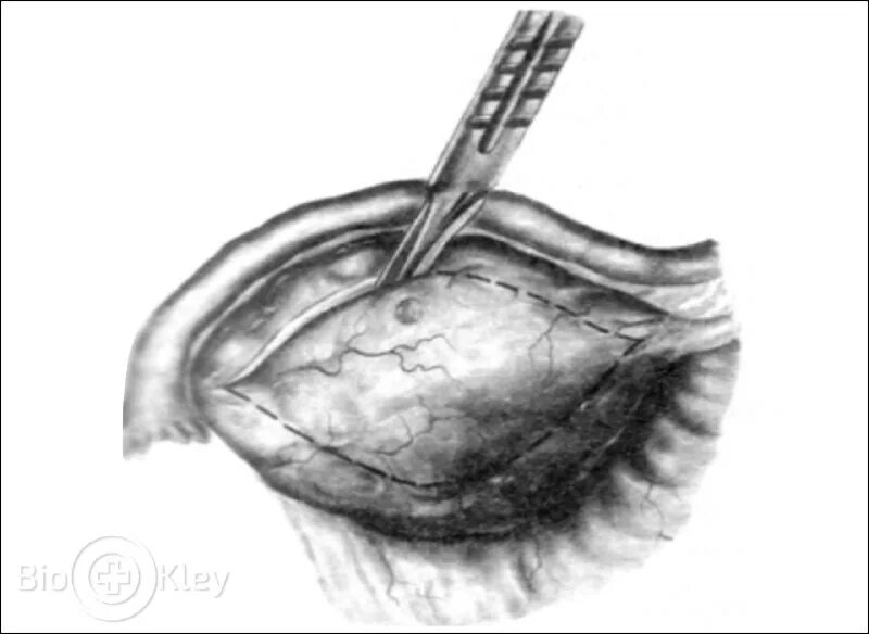 биопсия яичника у женщин