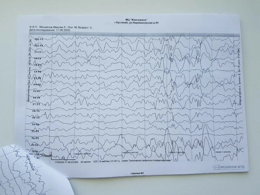 Ээг отзывы детям. Вертексные потенциалы на ЭЭГ. ЭЭГ головного мозга ребенку норма. ЭЭГ здорового ребенка 2. Человек на ЭЭГ.