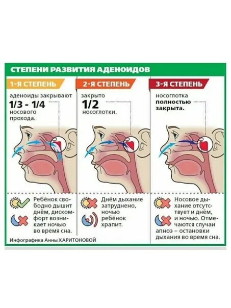 Аденоидный вегетация 3