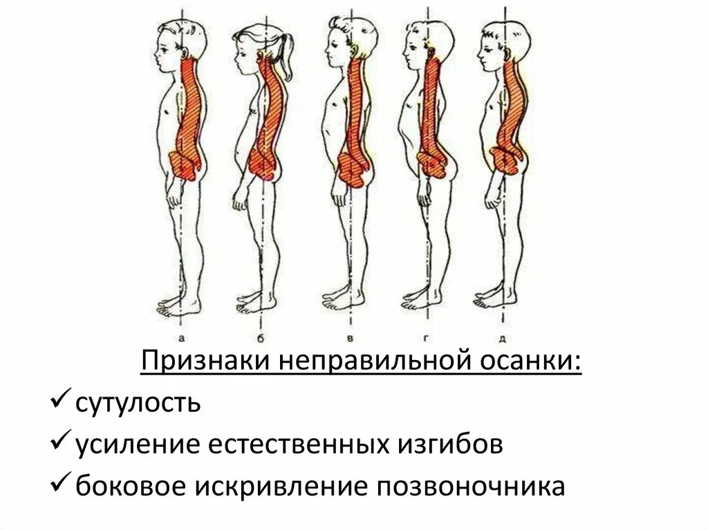 Круглая спина. Кругло вогнутая осанка. Вогнуто круглая спина. Круглая и кругловогнутая спина. Кругло вогнутая осанка.